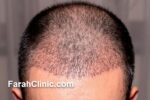راز موهای پرپشت و طبیعی؛ آشنایی با جدیدترین روش کاشت مو