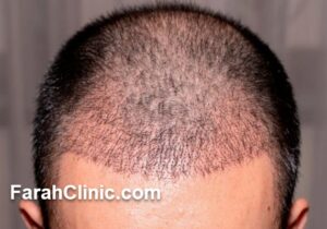 راز موهای پرپشت و طبیعی؛ آشنایی با جدیدترین روش کاشت مو