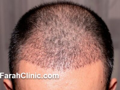 راز موهای پرپشت و طبیعی؛ آشنایی با جدیدترین روش کاشت مو