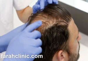 روش جدید کاشت مو در غرب تهران